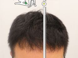 -大麦微针植发全国连锁