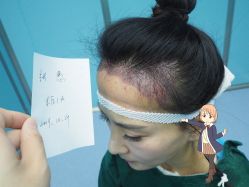 -大麦微针植发丨全国连锁