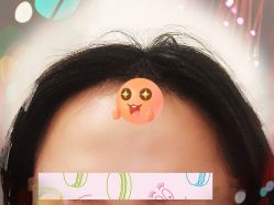 -大麦微针植发全国连锁