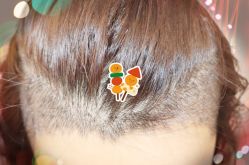 -大麦微针植发全国连锁