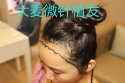 -大麦微针植发丨全国连锁