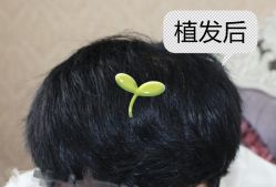 -大麦微针植发全国连锁