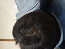 -大麦微针植发丨全国连锁