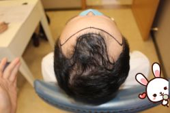 -大麦微针植发丨全国连锁