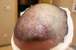 -大麦微针植发丨全国连锁