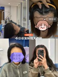 -大麦微针植发全国连锁