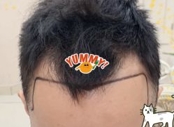 -大麦微针植发全国连锁