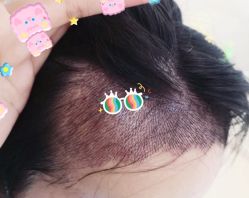 -大麦微针植发全国连锁