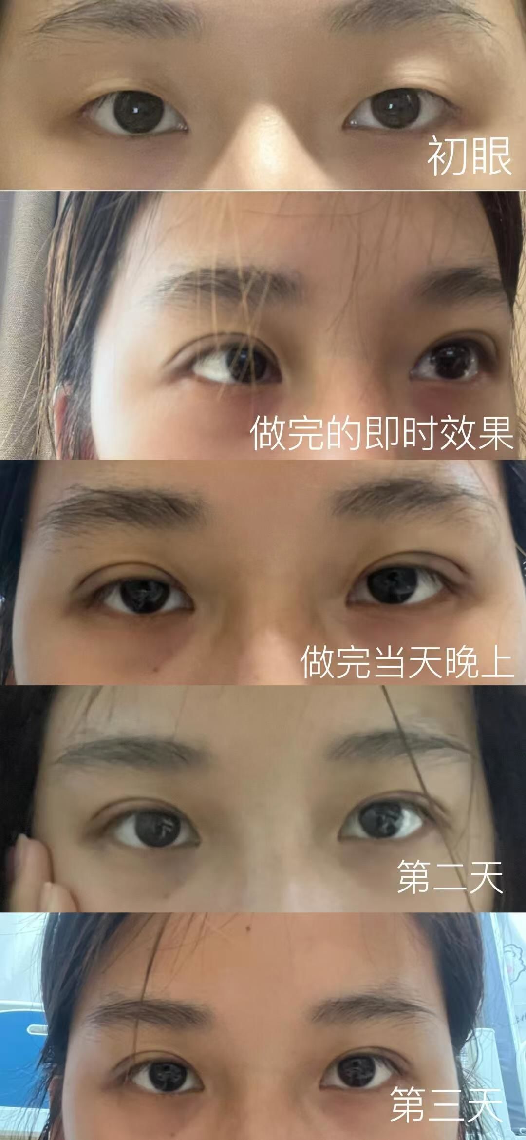 埋线双眼皮