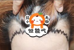 -大麦微针植发全国连锁