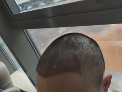 -碧莲盛·不剃发植发