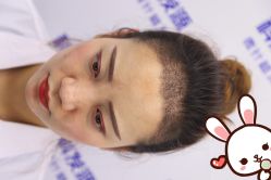 -大麦微针植发丨全国连锁