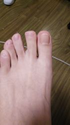点击看大图 -德哥灰指甲脚气甲沟炎跖疣护理