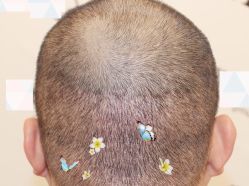 -大麦微针植发全国连锁