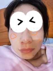 体验前-成都西区医院整形美容