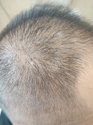 -碧莲盛·不剃发植发