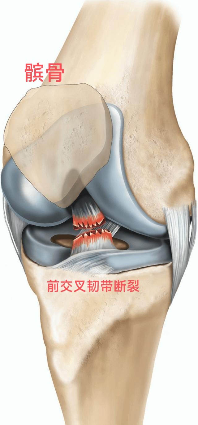 后交叉韧带示意图图片