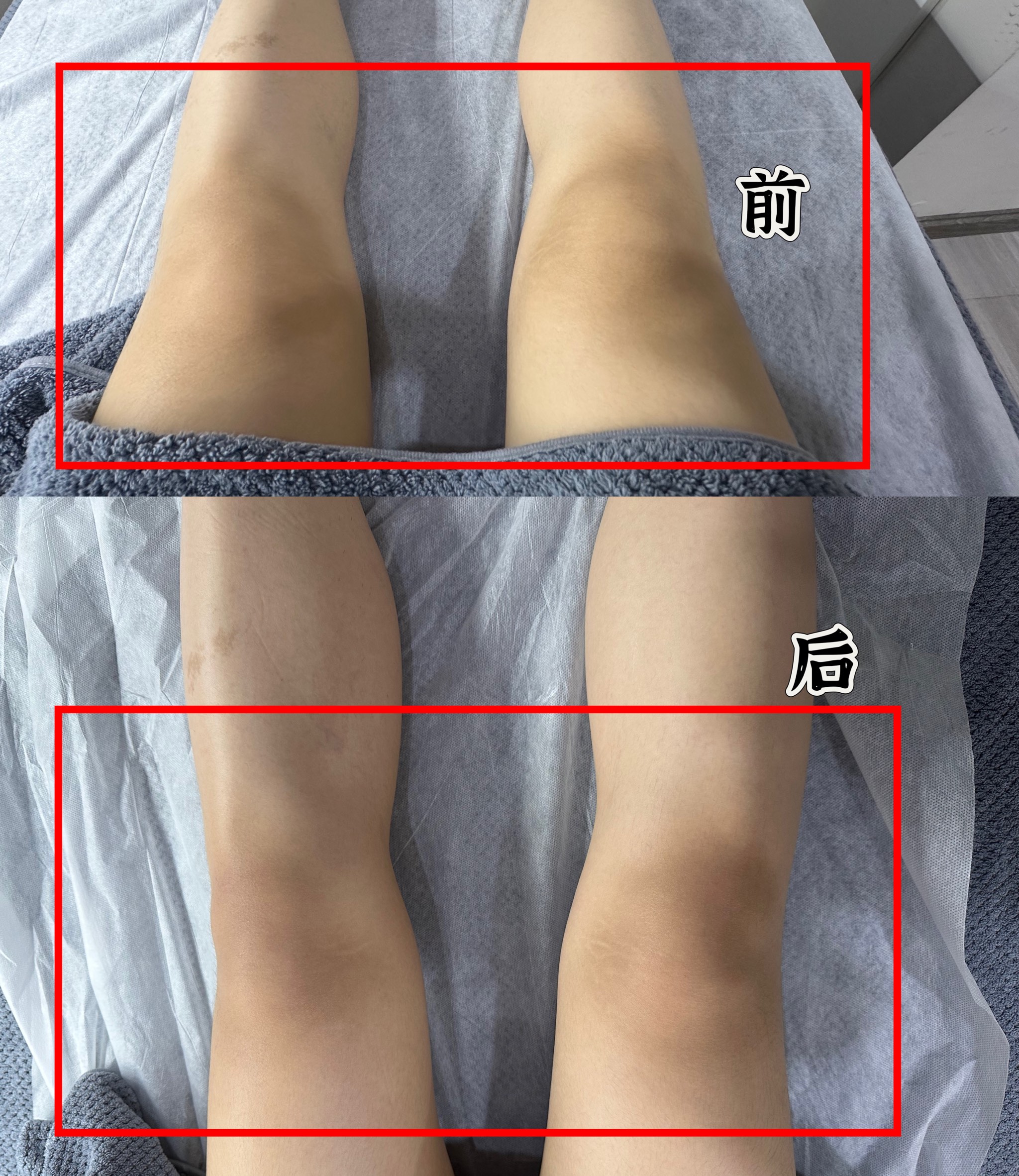 瘦小腿前后对比原图图片