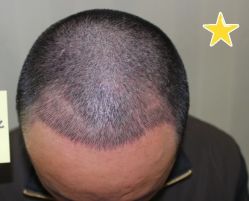 -大麦微针植发丨全国连锁