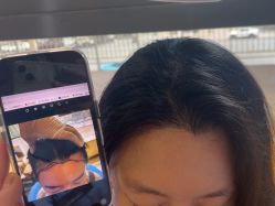 -碧莲盛·不剃发植发