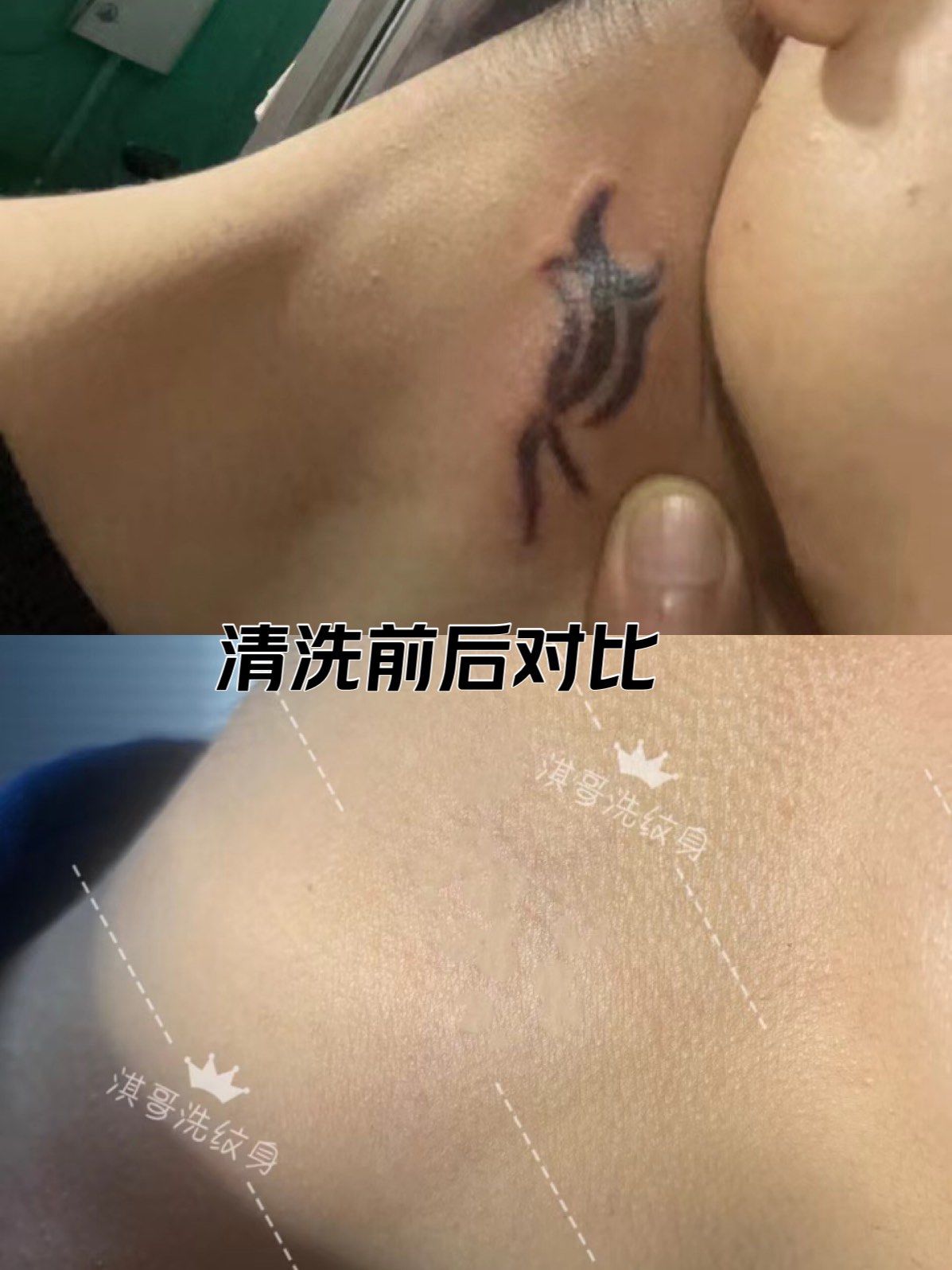 洗纹身脖子清洗前后对比