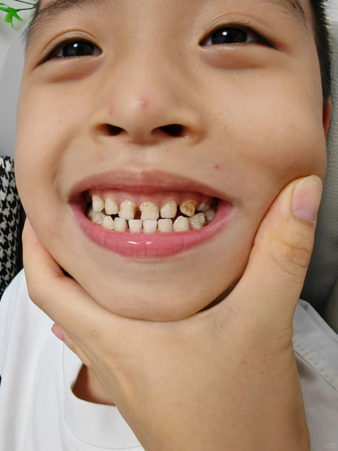 我家宝宝的牙齿从小就让我特别费心,哪有小朋友一岁多就开始蛀牙的啊