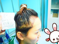 点击看大图 -大麦微针植发丨全国连锁