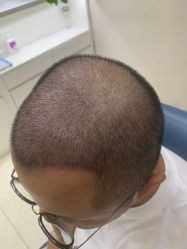 体验后-大麦微针植发丨全国连锁