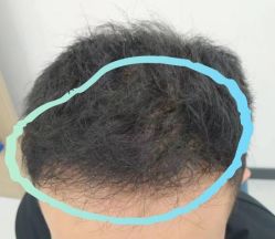 -大麦微针植发全国连锁