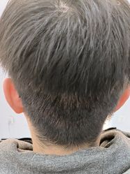 -大麦微针植发全国连锁