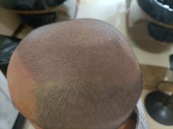 -碧莲盛·不剃发植发