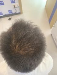 -大麦微针植发全国连锁
