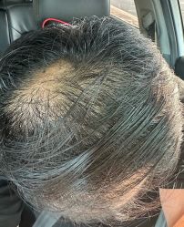 体验前-大麦微针植发全国连锁