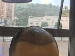 -碧莲盛·不剃发植发