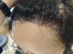 -碧莲盛·不剃发植发