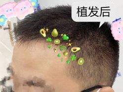 -大麦微针植发全国连锁