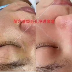 -苗方清颜专业祛痘连锁机构