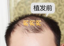 -大麦微针植发全国连锁