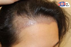 -大麦微针植发丨全国连锁