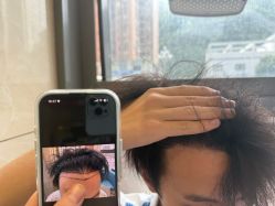 -碧莲盛·不剃发植发