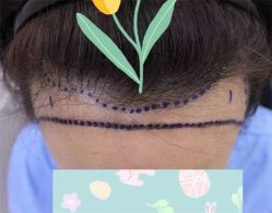 点击看大图 -大麦微针植发全国连锁
