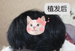-大麦微针植发全国连锁
