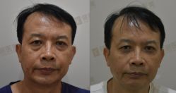 点击看大图 体验前-广州健丽·去眼袋医疗美容机构