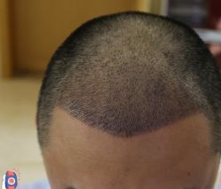 -大麦微针植发丨全国连锁