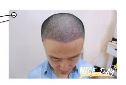 点击看大图 体验后-大麦微针植发全国连锁