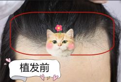 -大麦微针植发全国连锁