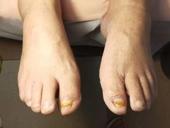 -世龙世家灰指甲鸡眼脚气甲沟炎跖疣护理(通州店)