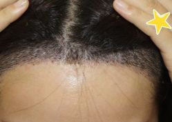 -大麦微针植发丨全国连锁