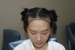 点击看大图 -大麦微针植发丨全国连锁