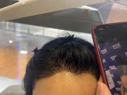 -碧莲盛·不剃发植发